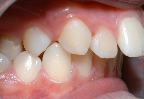 Răng hô là gì – 3 phương pháp khắc phục hiệu quả
